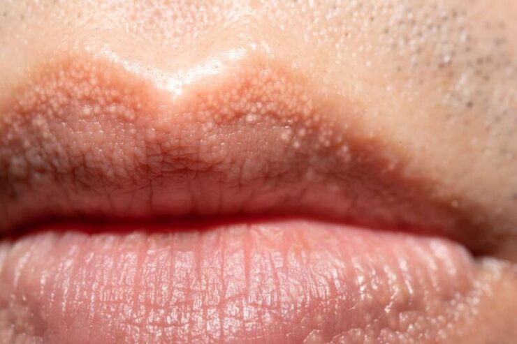 White Spots on Lips - Causes, Pictures, Small, on Lower, Upper, Inside Lip