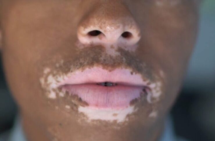 white Spots on Lips Causes