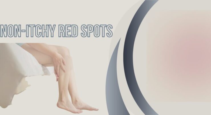 Non-Itchy Red Spots