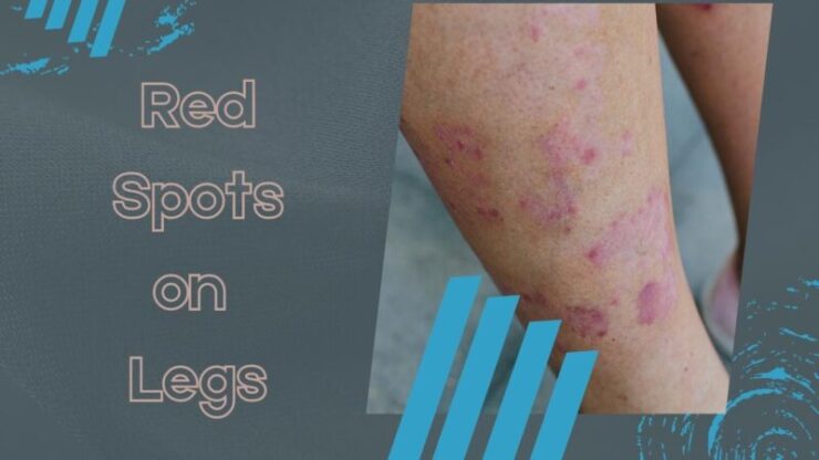 Red Spots on Legs: Causes, Small, Itchy, Non Itchy Dots on Legs