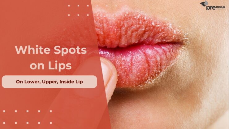 Causes of this white spots on lower, upper or inside lip