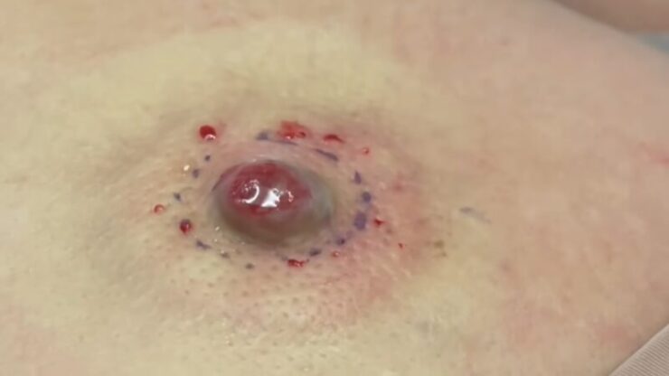 brown cyst
