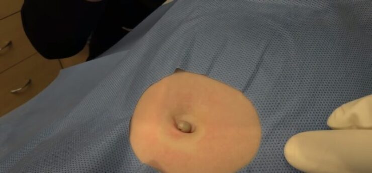 cyst belly button