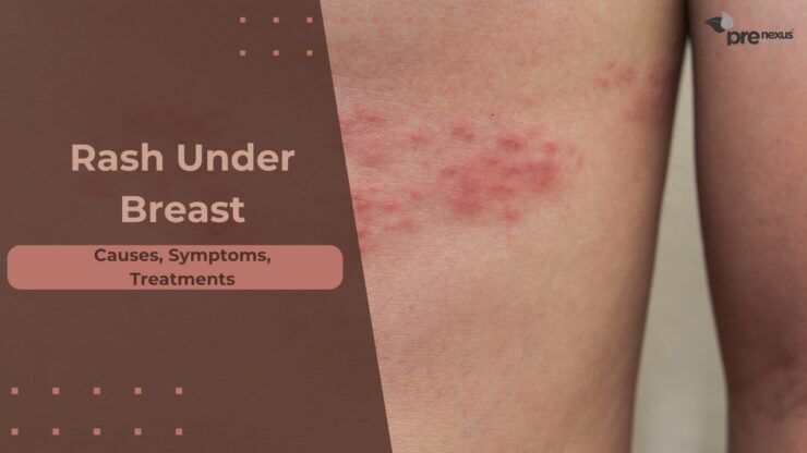 Causes, Symptoms and Effective Treatments for Rashes Under Breast
