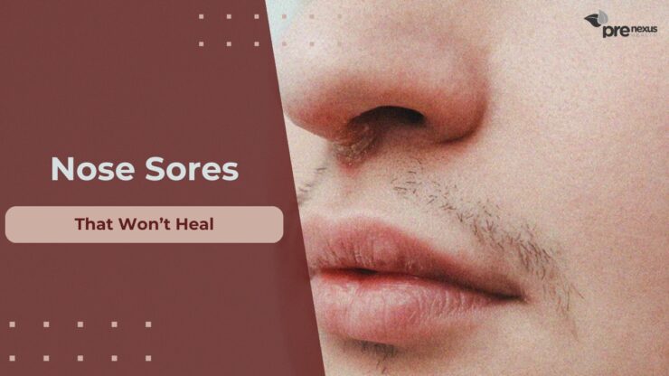 What to do with nose sores that won't go away